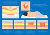 Bed Sore Prevention & Treatment: Essential Care Tips for Faster Healing