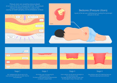 Bed Sore Prevention & Treatment: Essential Care Tips for Faster Healing