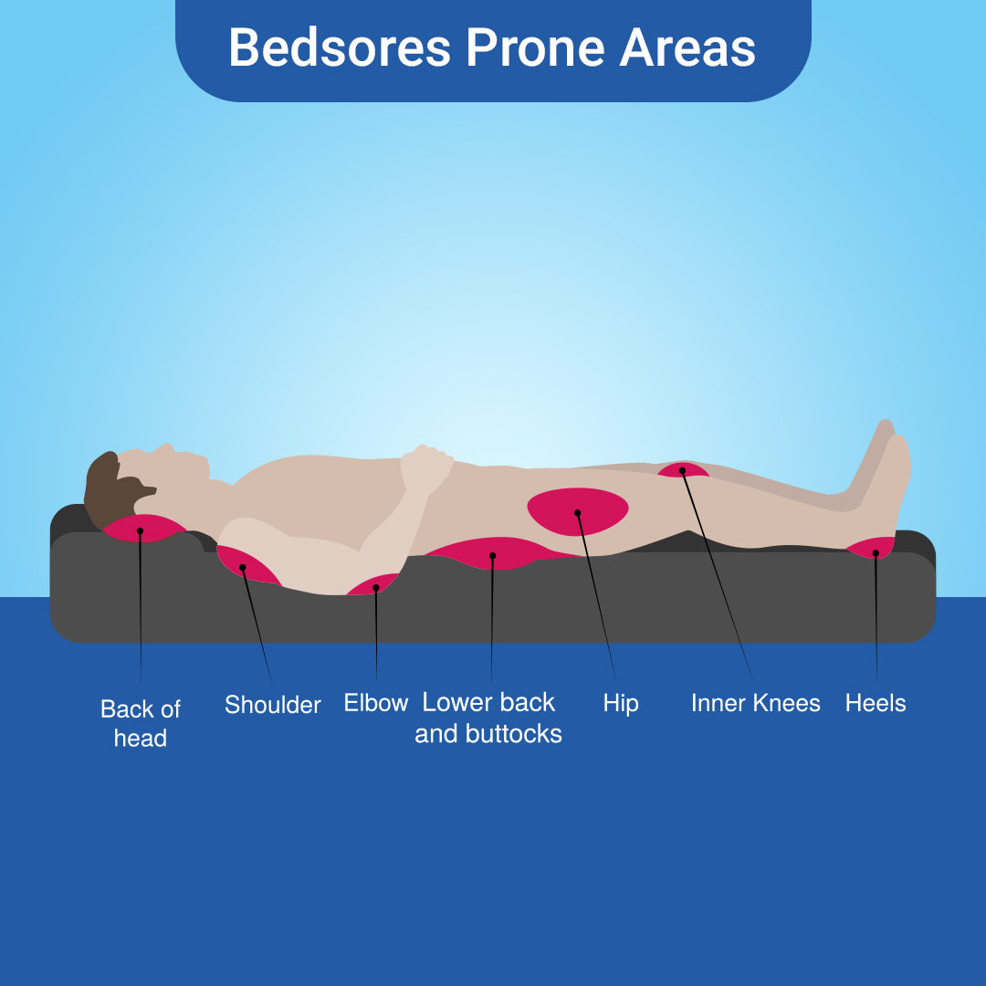 Bedsore Prevention Strategies: How the Right Mattress Makes a Difference