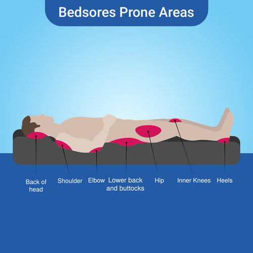 Bedsore Prevention Strategies: How the Right Mattress Makes a Difference