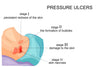 Diabetes & Bedsores: Why Diabetic Seniors Need Extra Skin Protection ?
