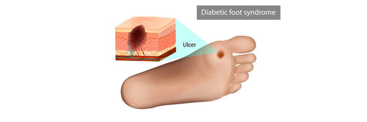 Diabetic Foot Ulcers – Causes, Symptoms & Prevention | Sorezecare