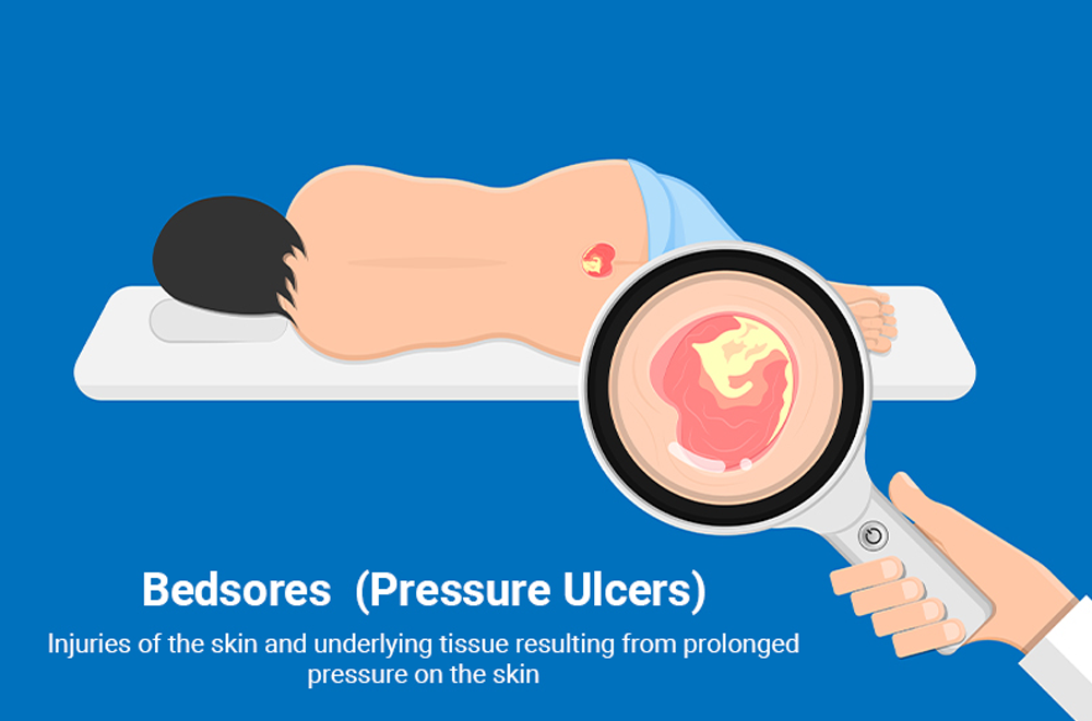 How Do Bedsores Happen? Causes, Stages & Complications